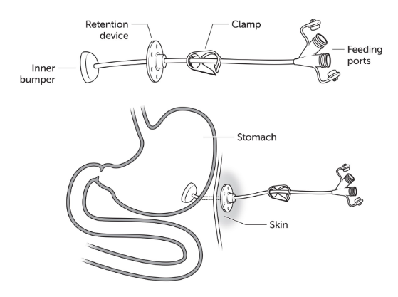 Gastrostomy tube